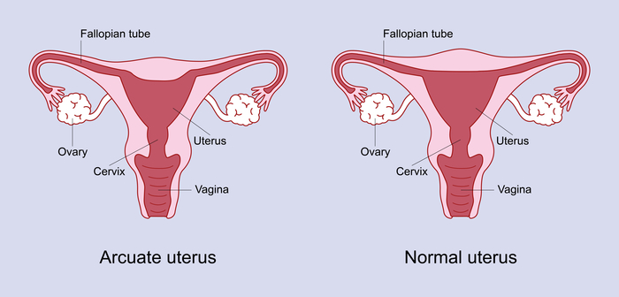 The arcuate uterus looks very similar to a normal uterus but has a small dip at the top of the womb.