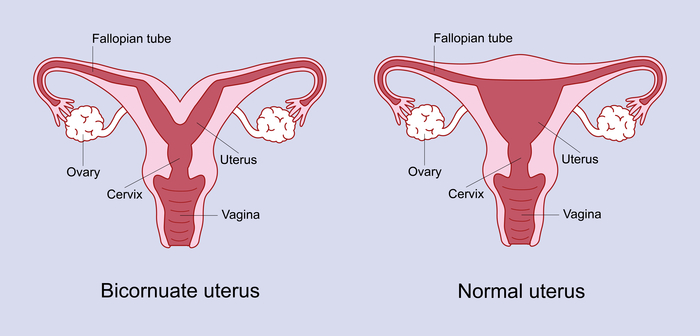 A bicornuate uterus has a deep indentation at the top of the uterus.