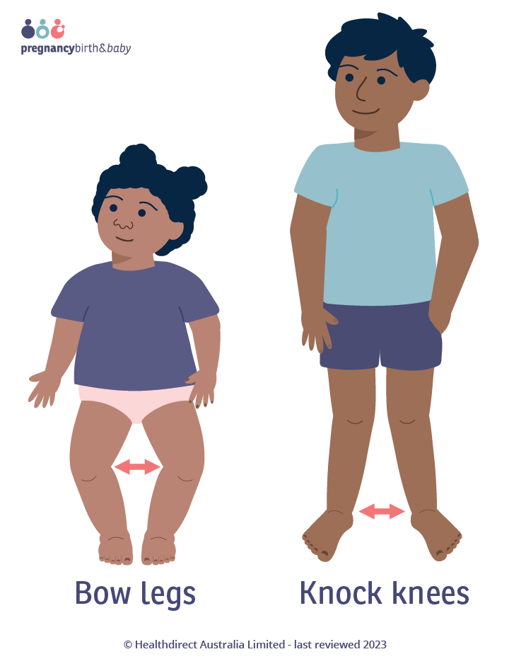 Illustration of a child with bow legs standing next to an older child with knock knees.