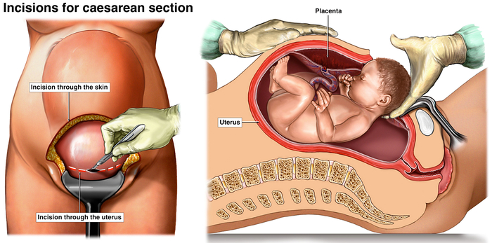 Images showing how a baby is born during a caesarean