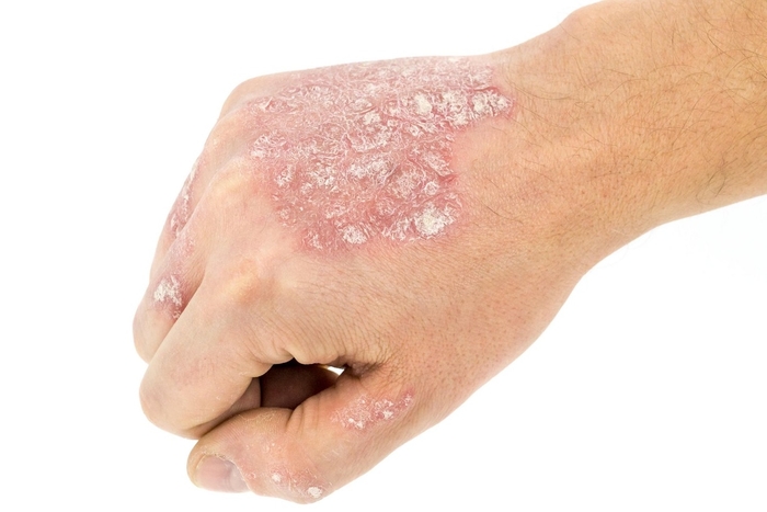 Image of Eczema on the back of the hand