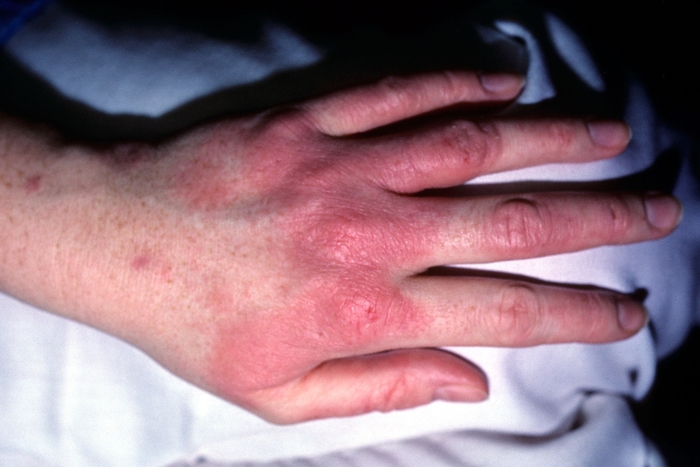 Image of Eczema on the back of the hand and fingers