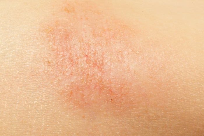 Close up of eczema on arm skin