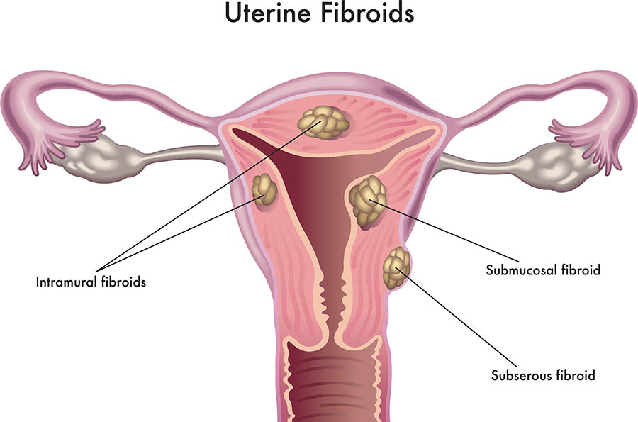 Illustration showing the anatomy of the uterus, with 4 different fibroid growths in the uterus and uterus muscle.