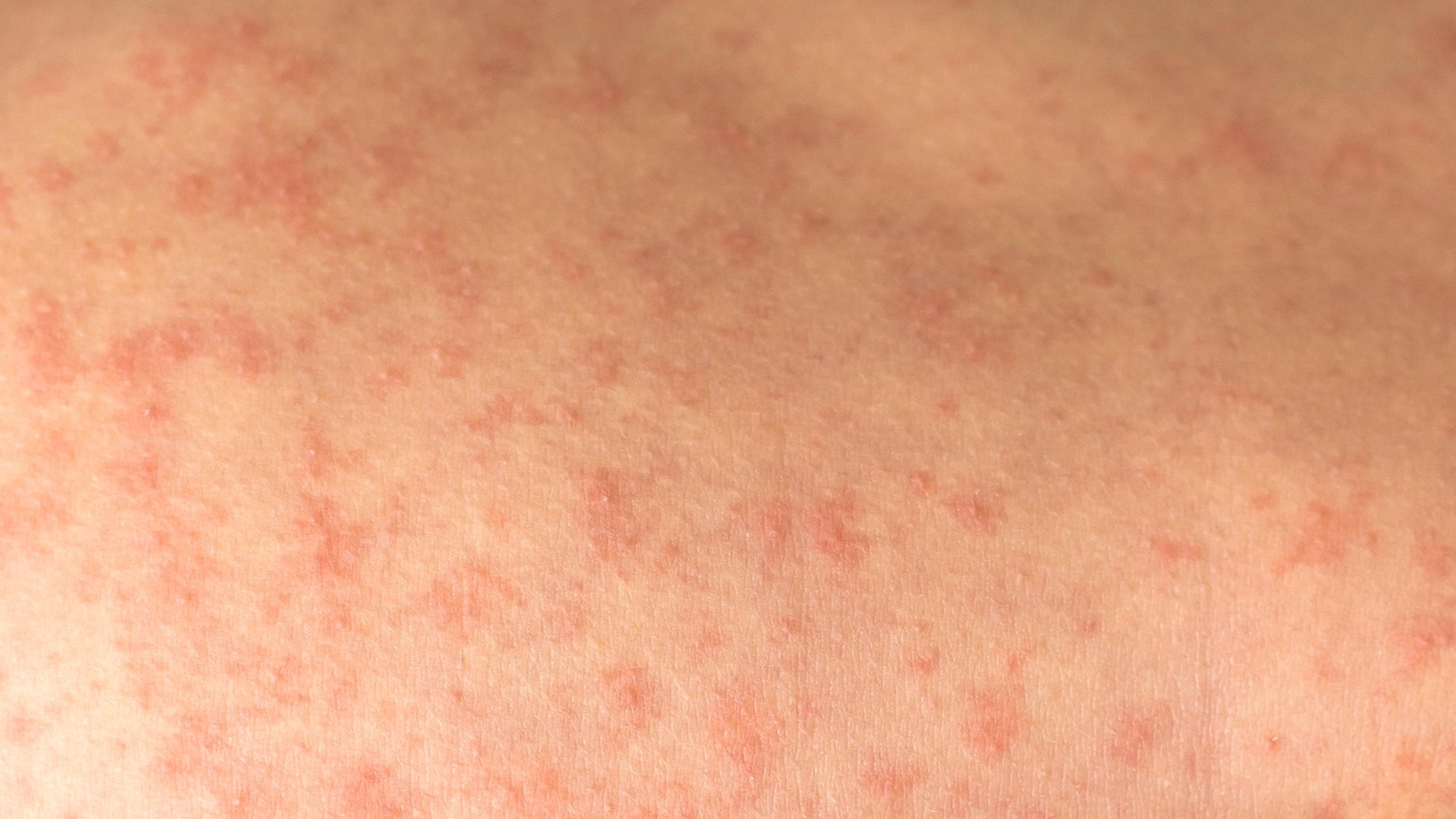 Image of measles rash