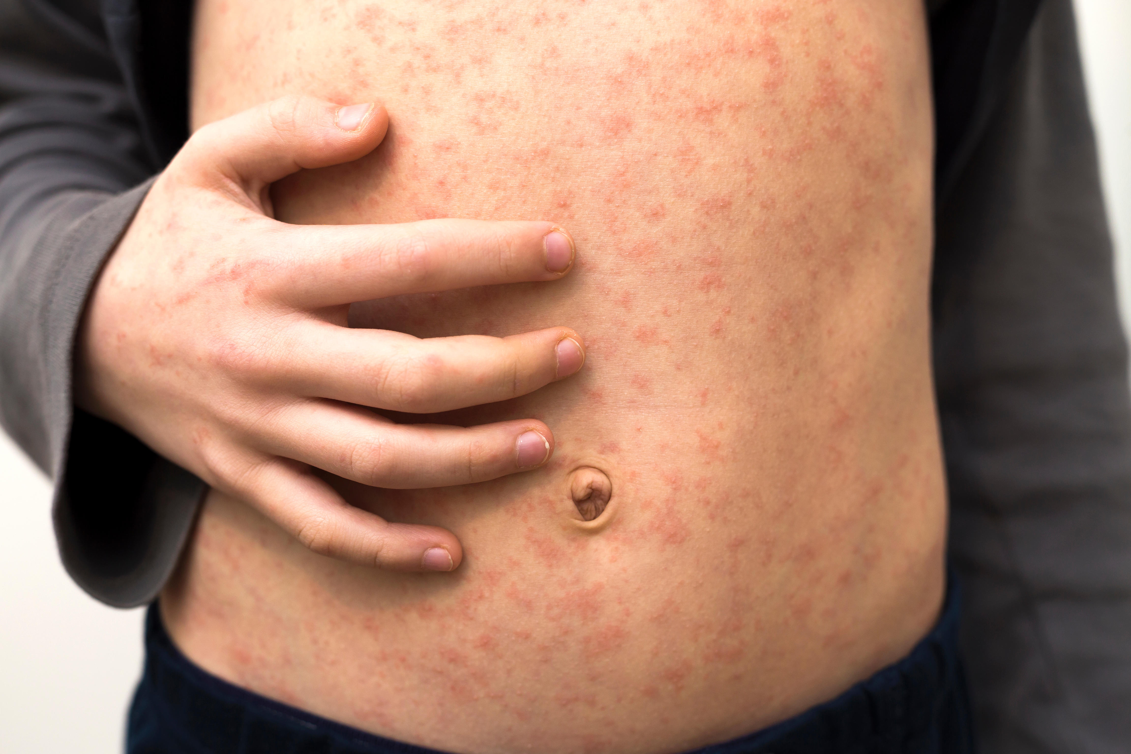 Image of measles rash