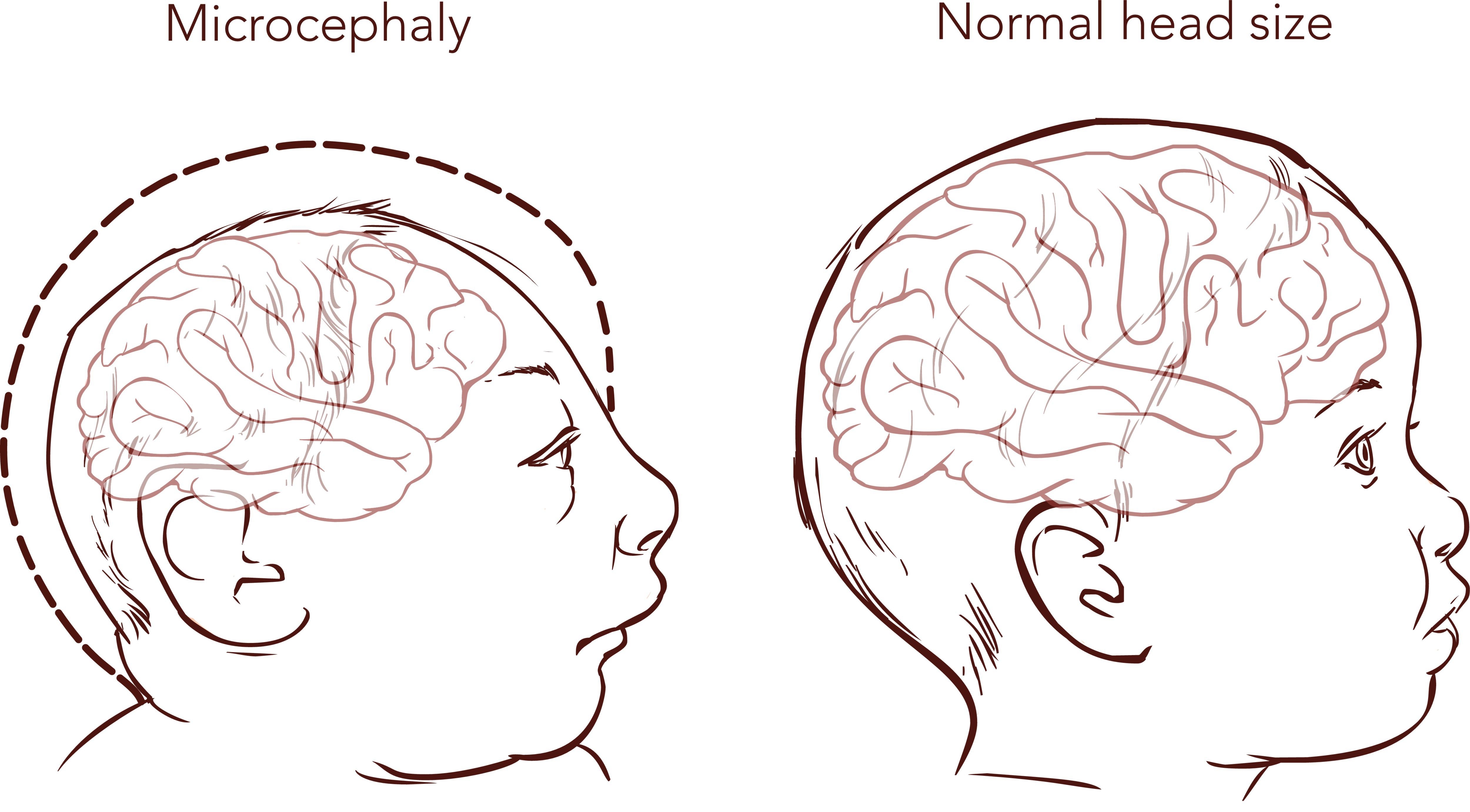 Small head size is the main symptom of the microcephaly.
