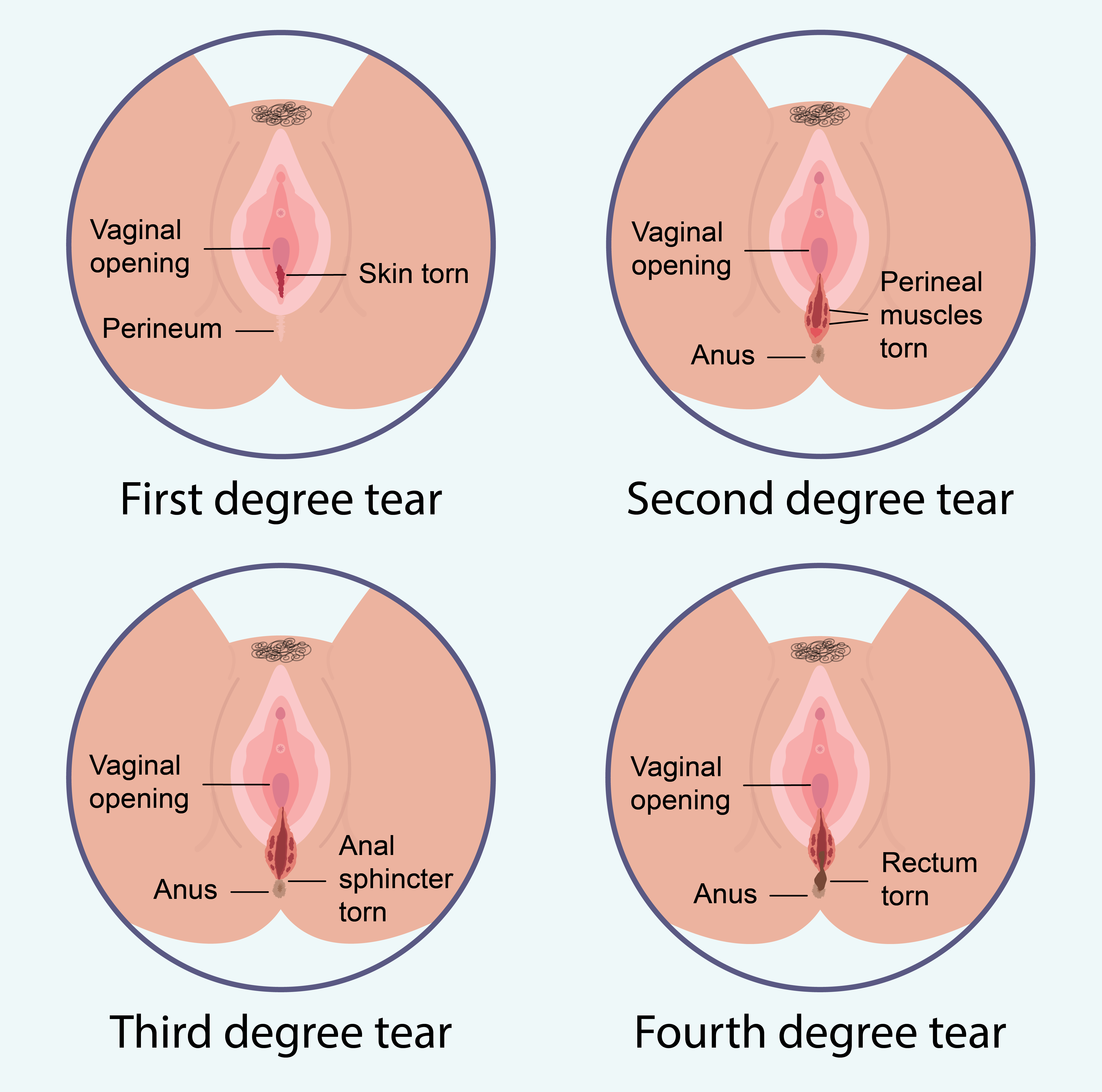 Illustration showing the four different degrees of perineal tears.