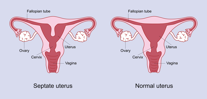 A septate womb has a wall of muscle that comes down the centre of the uterus and splits the uterus into two areas.