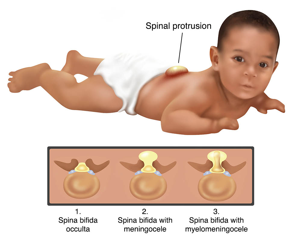 Illustration showing different types of spina bifida.