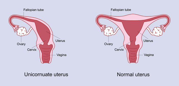 A unicornate uterus means that the womb is half the usual size, and occurs because half of the uterus didn’t develop as expected.