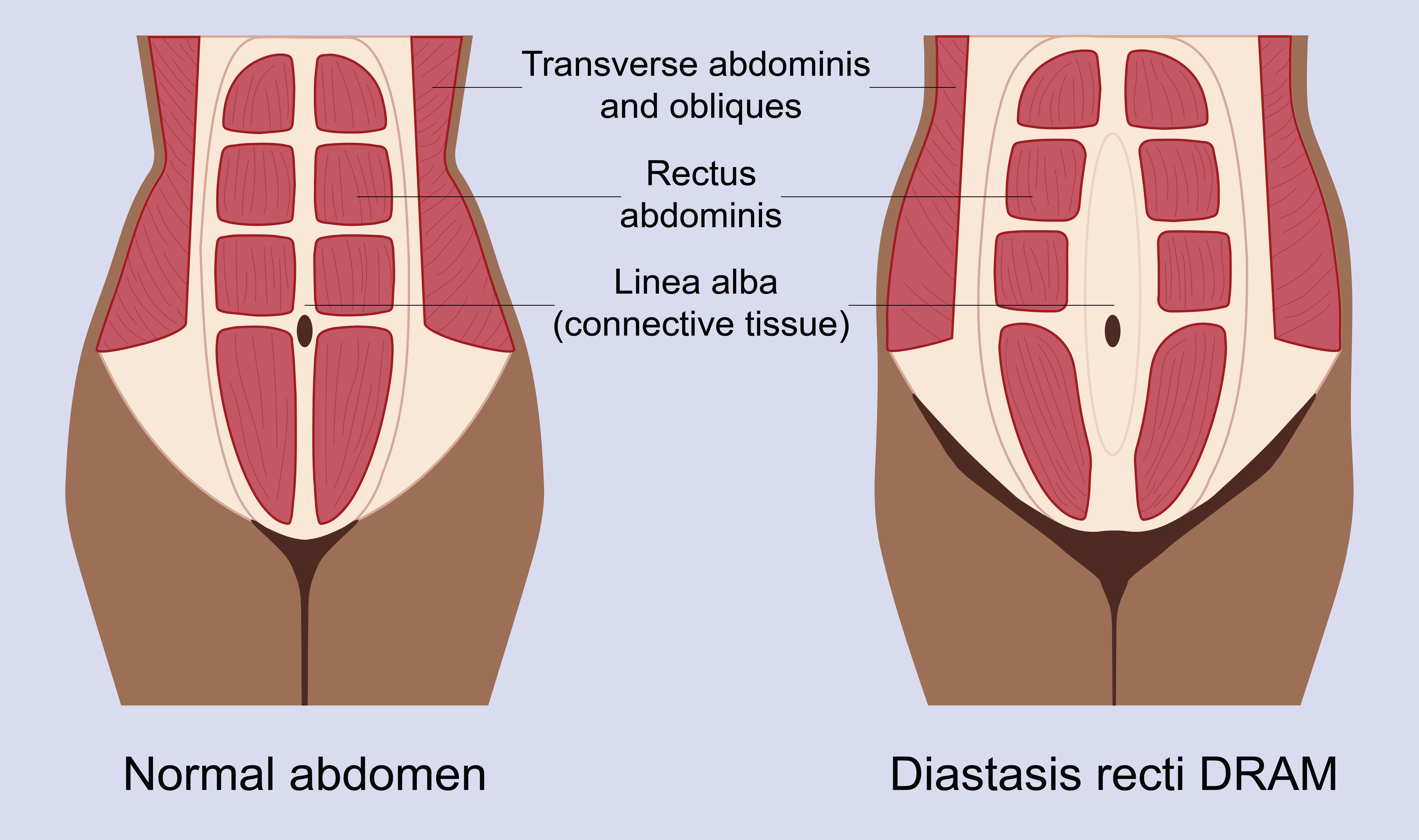 Abdominal separation (diastasis recti) Illustration of a body with normal abdominal muscles and a body with abdominal separation also known as diastasis recti DRAM.