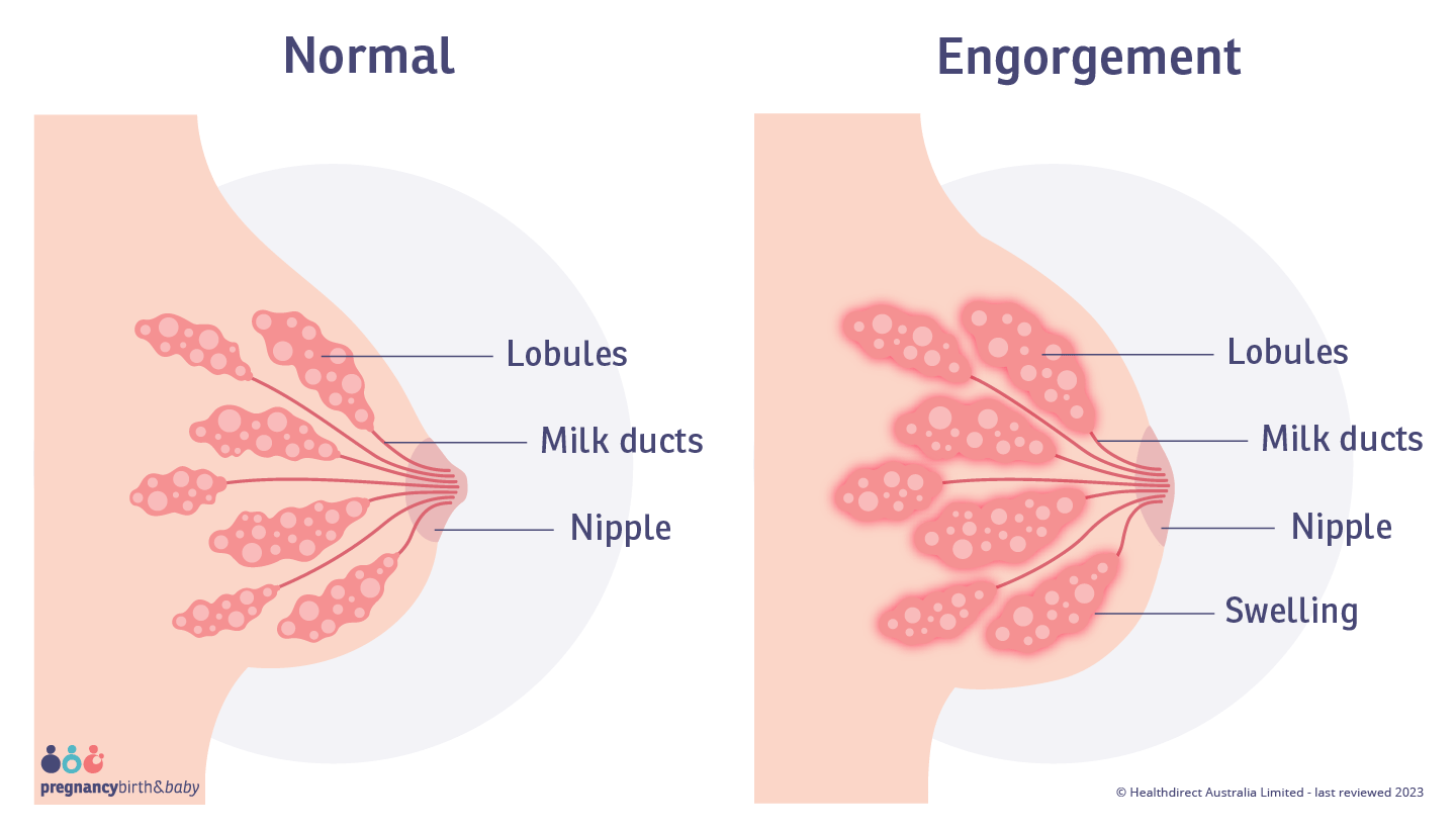 Landscape illustration of a normal breast, lobules and nipple, alongside a breast with engorgement, swollen lobules and a flat nipple.