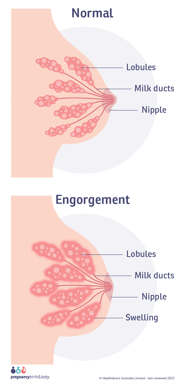 Portrait illustration of a normal breast and lobules, alongside a breast with engorgement and swollen lobules.