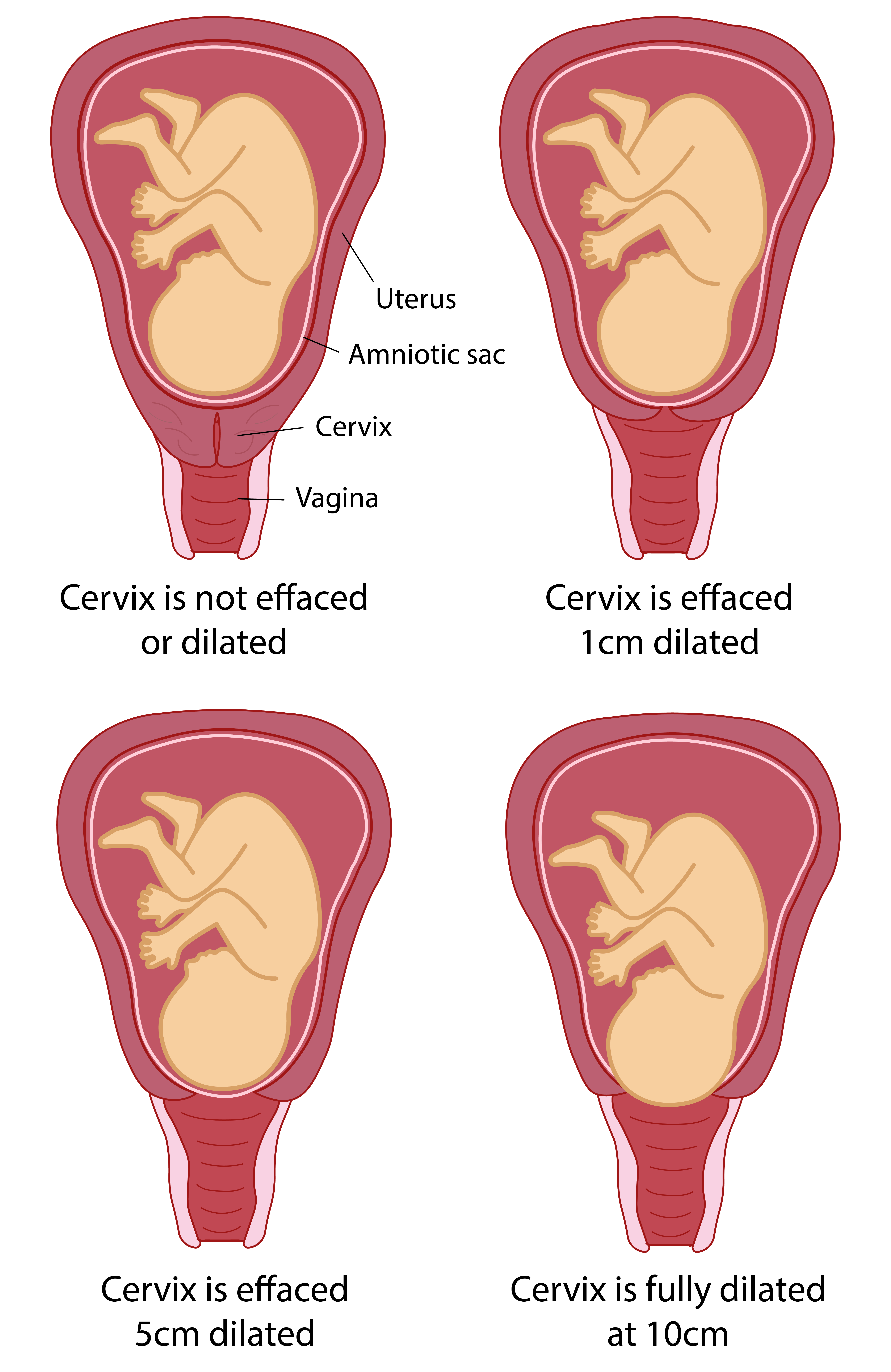 Illustration showing how the cervix dilates during labour.