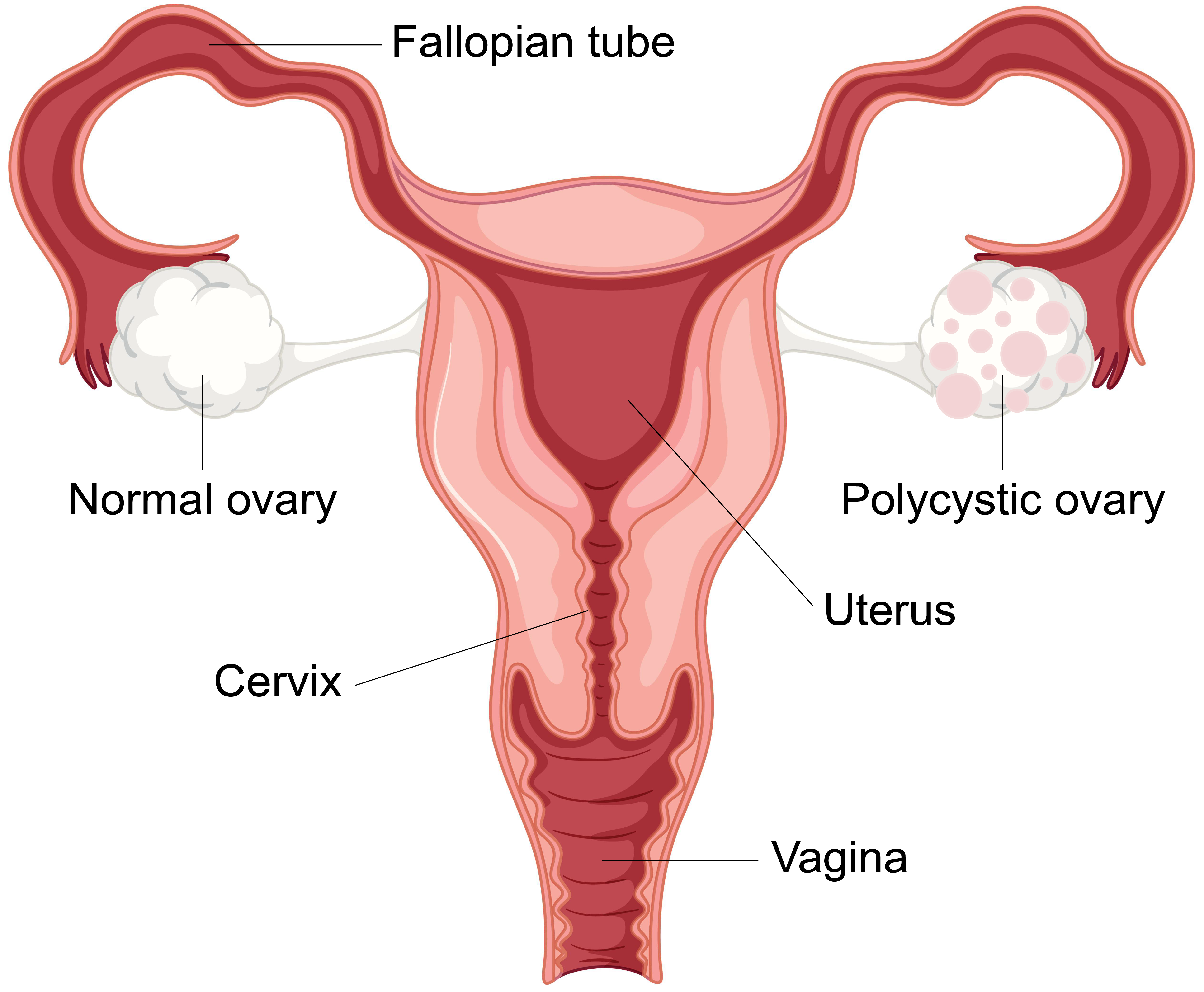 Illustration showing a normal ovary and a polycystic ovary.