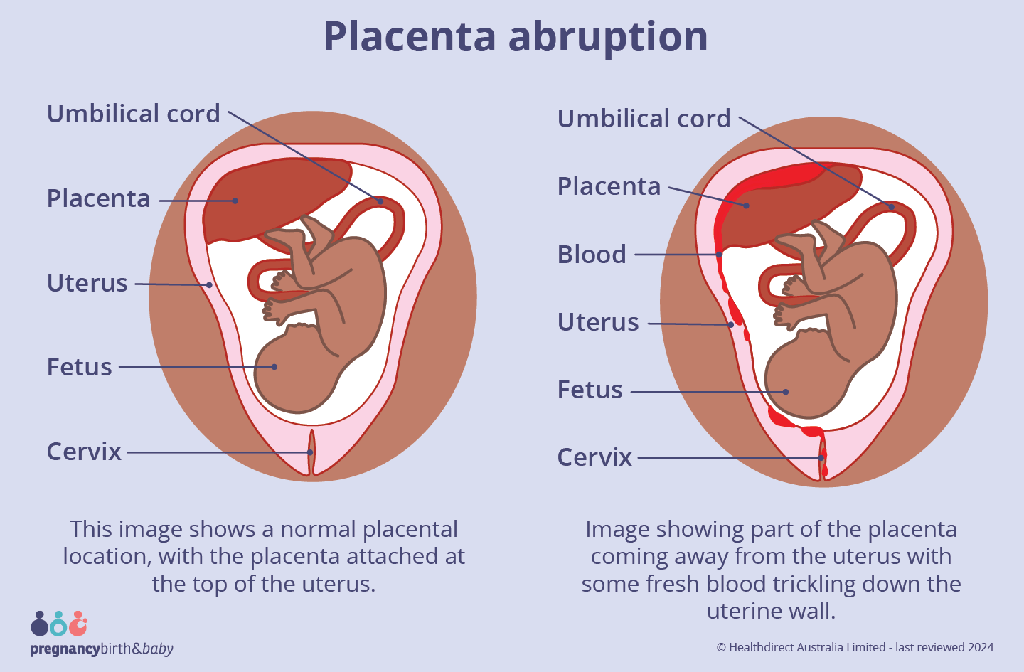 Image showing part of the placenta coming away from the uterus with some fresh blood trickling down the uterine wall