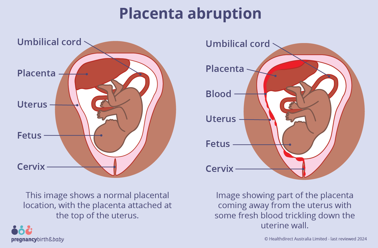 placenta abruption Image showing part of the placenta coming away from the uterus with some fresh blood trickling down the uterine wall