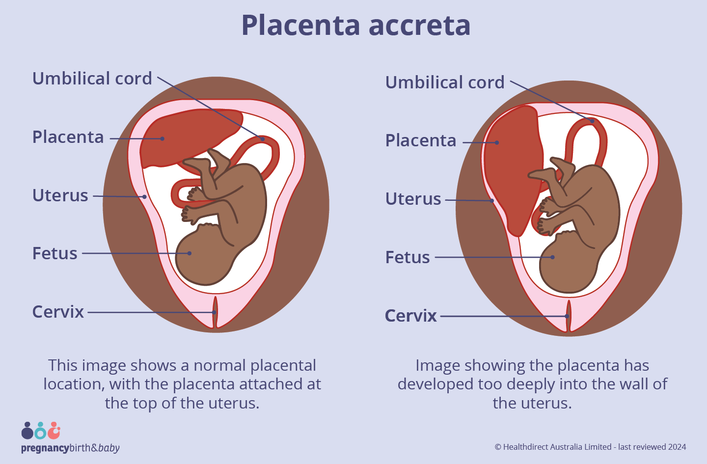 Placenta accreta Image showing the placenta has developed too deeply into the wall of the uterus.