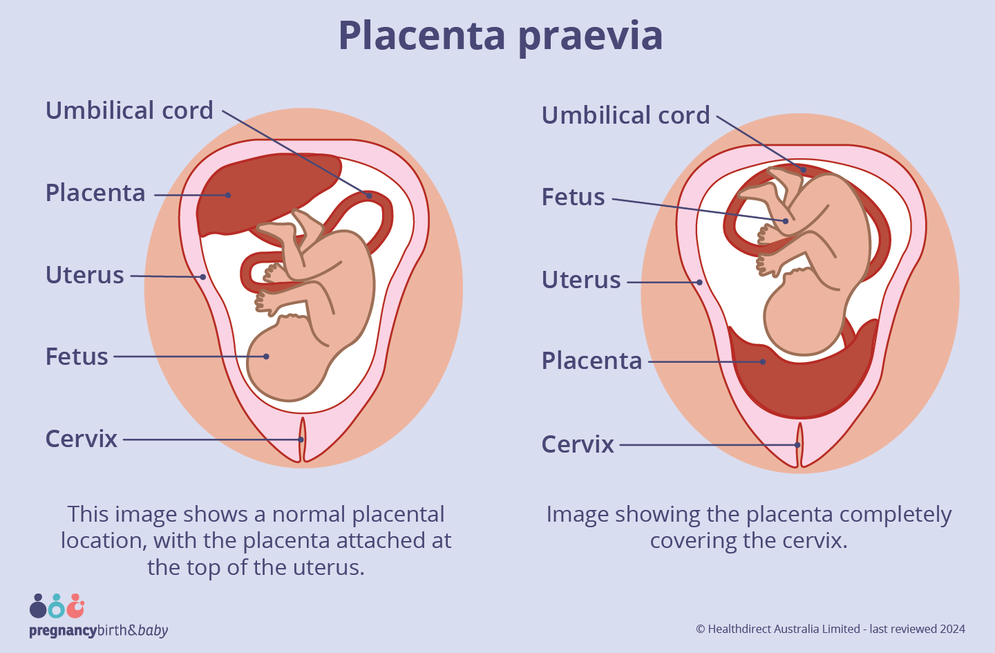 placenta praevia Image showing the placenta completely covering the cervix.