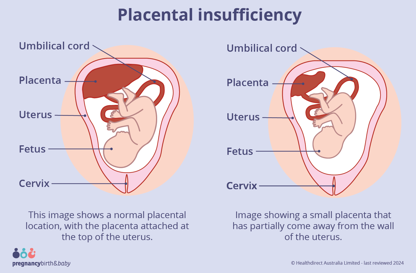 Image showing a small placenta that has partially come away from the wall of the uterus.