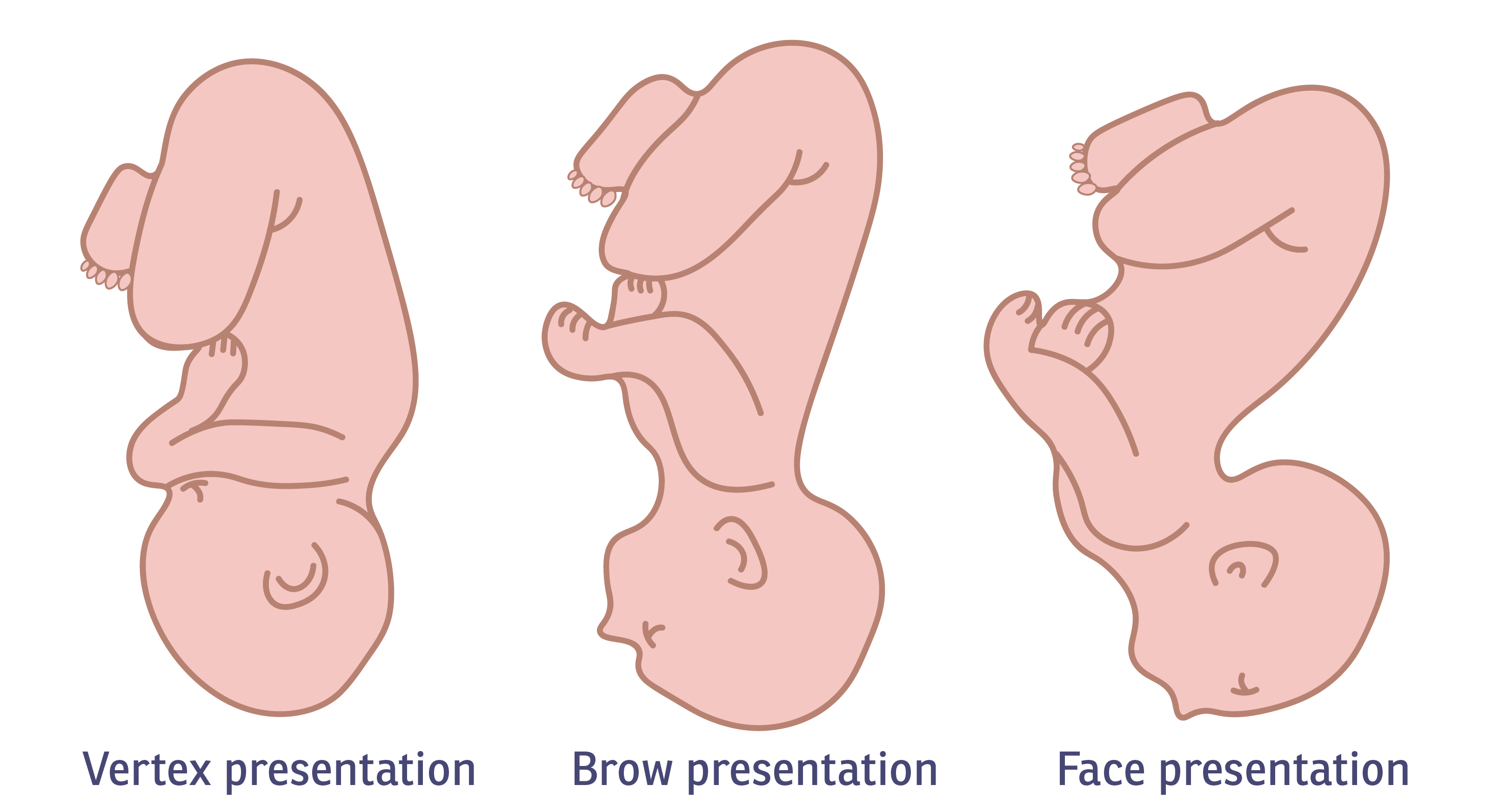 Vertex, brow and face presentations