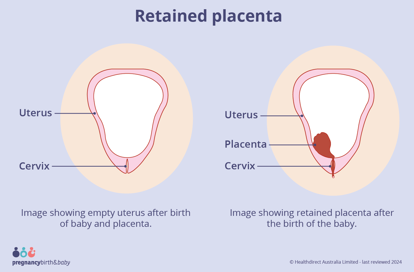 Image showing retained placenta after the birth of the baby.